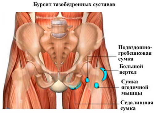 Импиджмент-синдром тазобедренного сустава. Симптомы, признаки, лечение