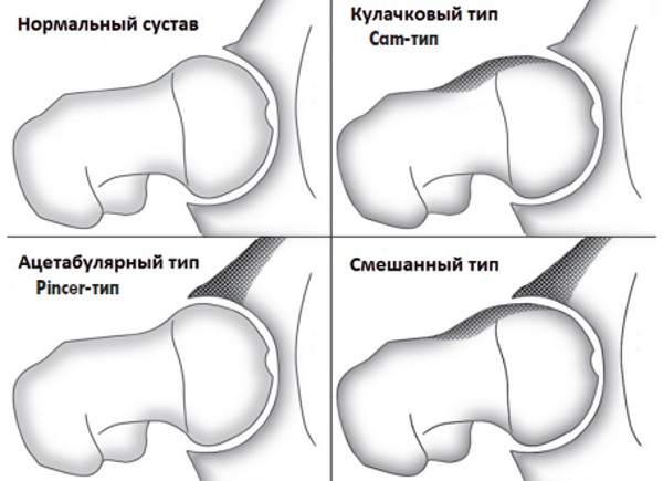 Импиджмент-синдром тазобедренного сустава. Симптомы, признаки, лечение