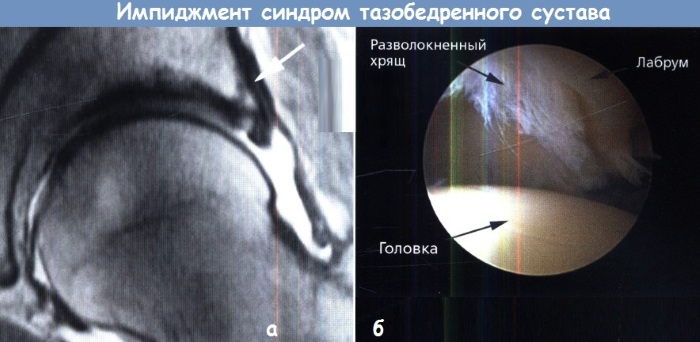 Импиджмент-синдром тазобедренного сустава. Симптомы, признаки, лечение