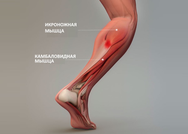 Камбаловидная мышца. Где находится, функции, анатомия, болит, причины, лечение