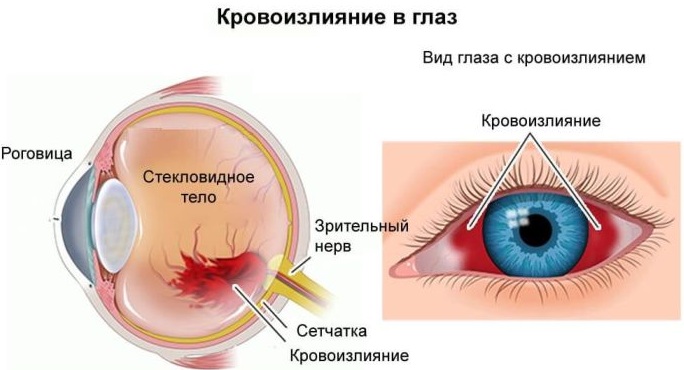 Расплывается изображение в глазах сбоку, вдалеке, вблизи. Причины, что капать