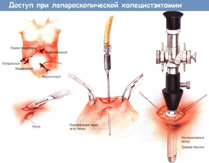 Лапароскопия желчного пузыря. Цена, сколько длится, реабилитационный период, диета
