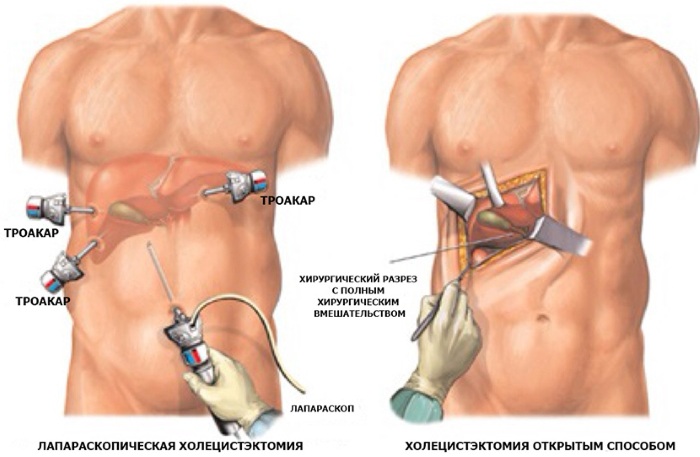 Лапароскопия желчного пузыря. Цена, сколько длится, реабилитационный период, диета
