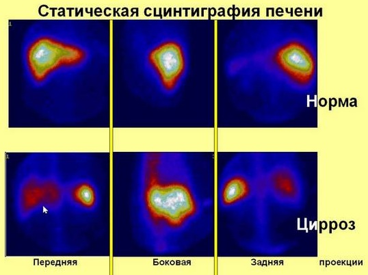 Лекарственный гепатит. Симптомы, лечение острого, хронического, рекомендации