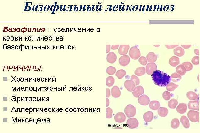 Лейкоцитоз крови. Что это такое у взрослых, ребенка, беременных, причины, лечение, последствия