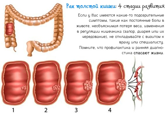 Метастазы в голове. Симптомы, признаки, лечение, прогноз срока жизни