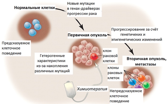 Синдром Золлингера-Эллисона. Что это такое, симптомы, лечение