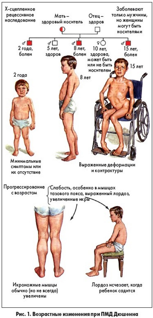 Миопатия Дюшена. Что это такое, симптомы у детей, взрослых, лечение