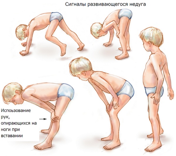 Миопатия Дюшена. Что это такое, симптомы у детей, взрослых, лечение