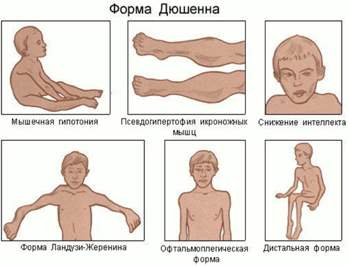 Миопатия Дюшена. Что это такое, симптомы у детей, взрослых, лечение