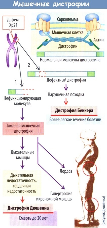 Миопатия Дюшена. Что это такое, симптомы у детей, взрослых, лечение