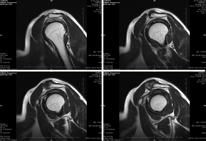 МРТ плечевого сустава. Цена, что показывает, как проходит процедура, что можно обнаружить