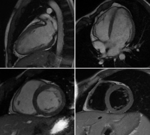 МРТ сердца. Что показывает с контрастированием и без, как делают, показания