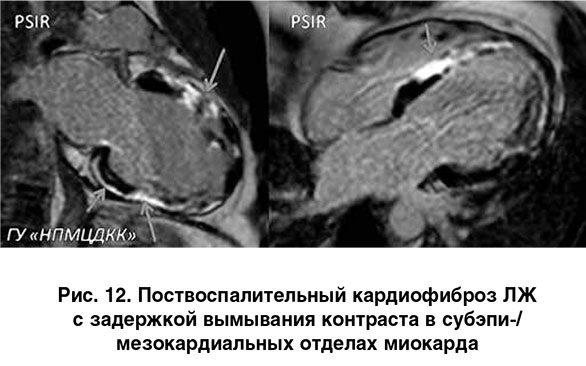 МРТ сердца. Что показывает с контрастированием и без, как делают, показания