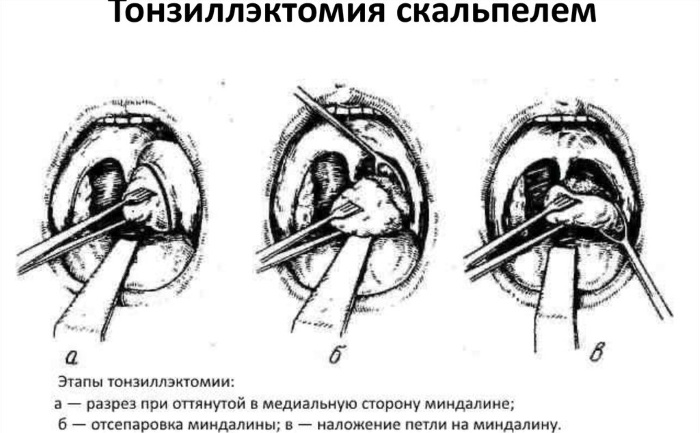 Лечение хронического тонзиллита у взрослых схема лечения