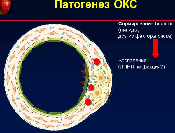 ОКС c подъемом сегмента ST. Клинические рекомендации, симптомы, лечение