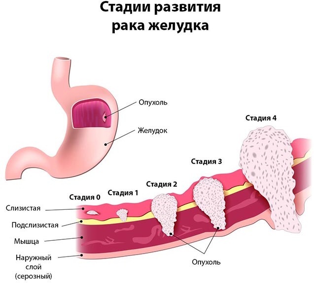 Опухоль в желудке. Симптомы, что это может быть, доброкачественная, злокачественная, лечение