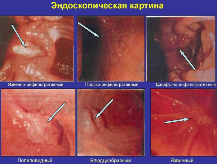 Опухоль в желудке. Симптомы, что это может быть, доброкачественная, злокачественная, лечение