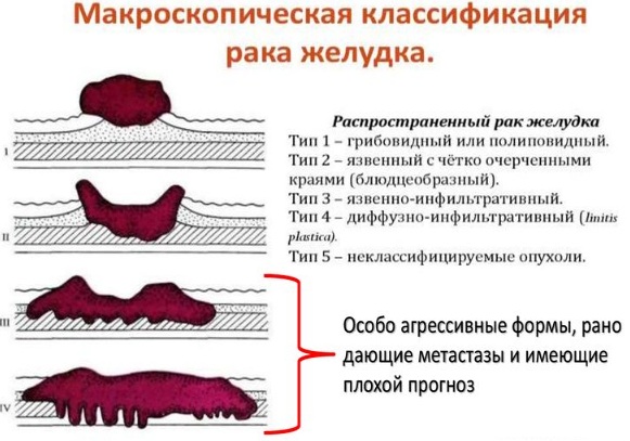 Опухоль в желудке. Симптомы, что это может быть, доброкачественная, злокачественная, лечение