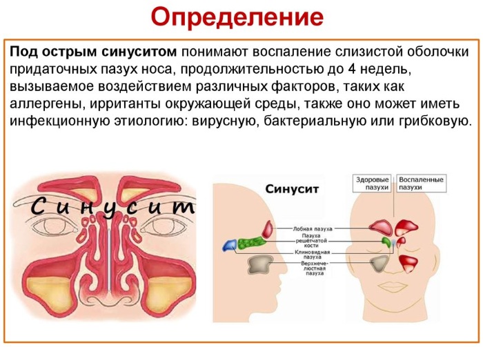 Острый синусит. Что это такое, симптомы, лечение у взрослых, детей