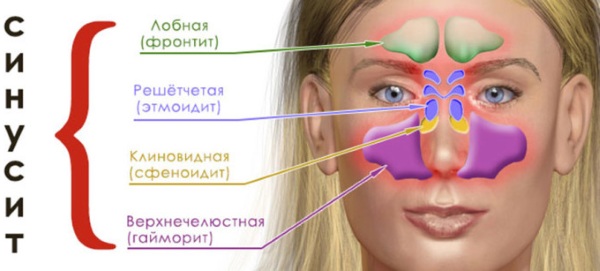 Острый синусит. Что это такое, симптомы, лечение у взрослых, детей