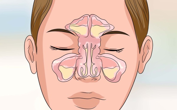 Острый синусит. Что это такое, симптомы, лечение у взрослых, детей
