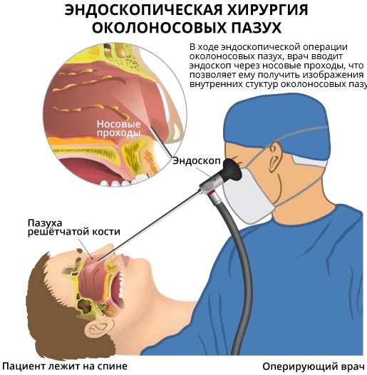 Острый синусит. Что это такое, симптомы, лечение у взрослых, детей