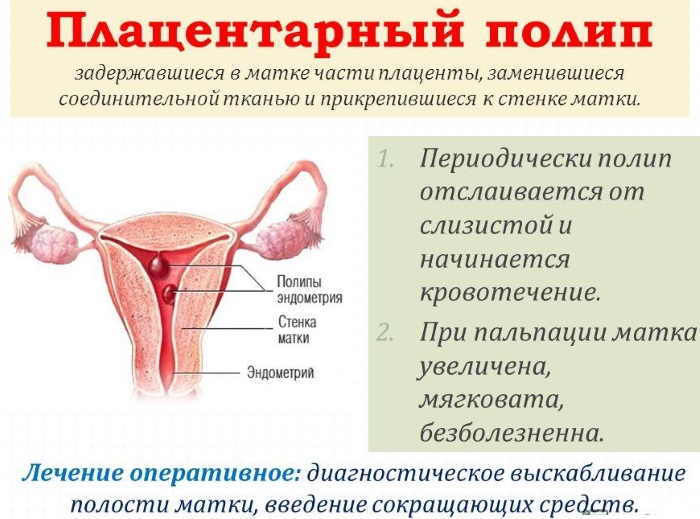 Плацентарный полип. Что это такое, анатомия, лечение после родов, медаборта, чистки замершей беременности, выкидыша