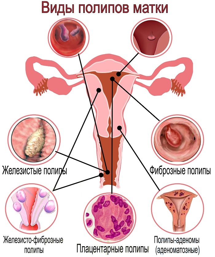 Плацентарный полип. Что это такое, анатомия, лечение после родов, медаборта, чистки замершей беременности, выкидыша