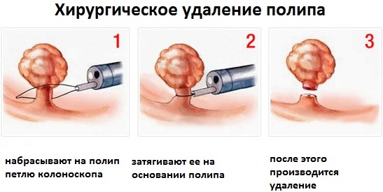 Плацентарный полип. Что это такое, анатомия, лечение после родов, медаборта, чистки замершей беременности, выкидыша