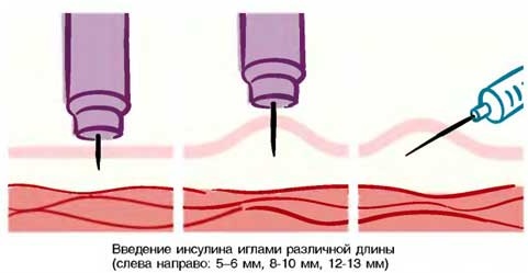 Подкожная инъекция в плечо, живот, бедро. Техника выполнения, введения