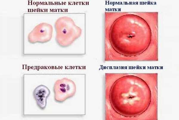 Предраковое состояние шейки матки. Что это такое, название, лечение 1-2-3 степени