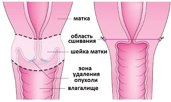 Предраковое состояние шейки матки. Что это такое, название, лечение 1-2-3 степени