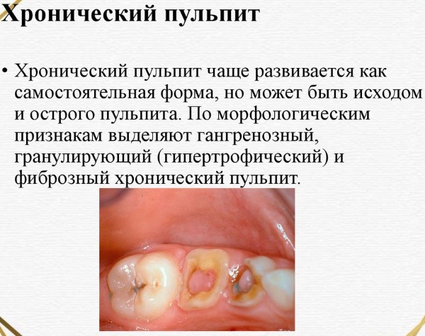 Пульпиты. Классификация, диагностика, лечение у детей, взрослых, симптомы, причины, виды