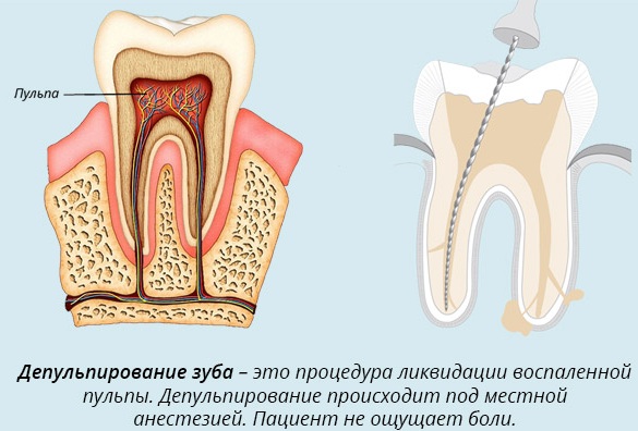 Пульпиты. Классификация, диагностика, лечение у детей, взрослых, симптомы, причины, виды