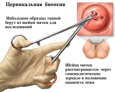 Расширенная кольпоскопия. Что это за анализ, что показывает, показания, подготовка