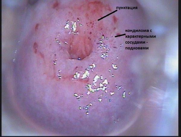 Расширенная кольпоскопия. Что это за анализ, что показывает, показания, подготовка