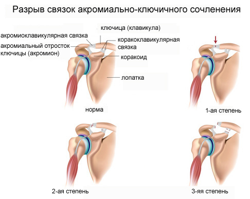 Разрыв сухожилий плечевого сустава. Лечение после операции народными средствами, симптомы, как долго заживает