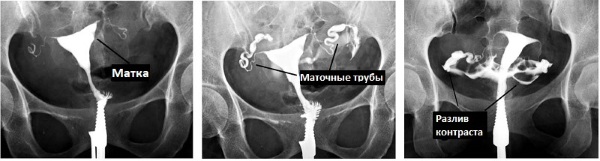 Retroflexio матка (загиб матки). Что значит, как забеременеть, причины, симптомы, лечение