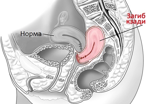 Retroflexio матка (загиб матки). Что значит, как забеременеть, причины, симптомы, лечение