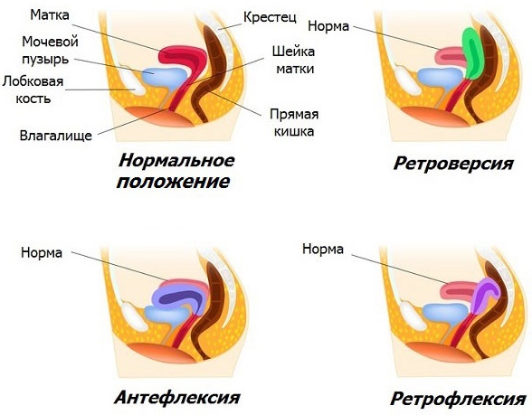 Что значит положение антефлексио