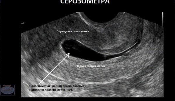 Серозометра в постменопаузе. Лечение, отзывы, что это такое, причины