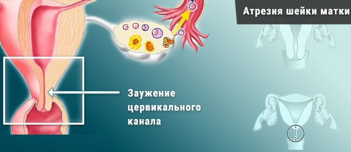 Серозометра в постменопаузе. Лечение, отзывы, что это такое, причины