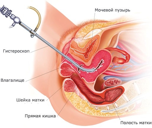 Серозометра в постменопаузе. Лечение, отзывы, что это такое, причины