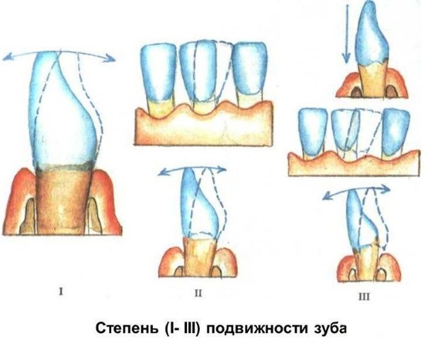 Шатаются зубы у взрослого. Причины, лечение, чем укрепить десна, медикаменты