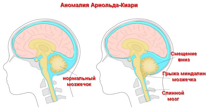 Синдром Арнольда-Киари. Что это, степени, симптомы у взрослых, детей, лечение, последствия