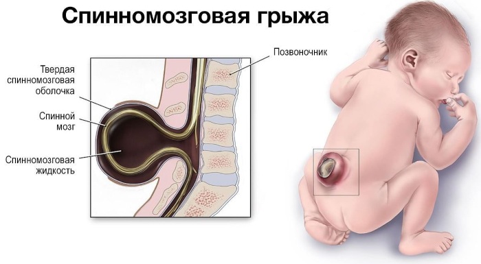 Синдром Арнольда-Киари. Что это, степени, симптомы у взрослых, детей, лечение, последствия