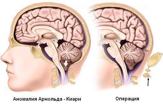 Синдром Арнольда-Киари. Что это, степени, симптомы у взрослых, детей, лечение, последствия