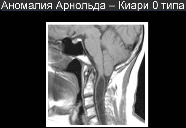 Синдром арнольда киари фото