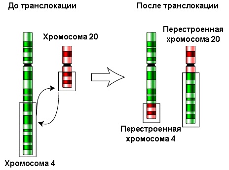 Синдром Дауна. Фото взрослых, детей, кариотип, причины, симптомы, признаки, лечение, диагностика, риск